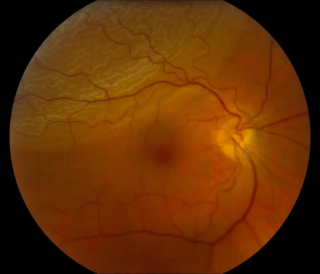 Distacco di retina oculista dottor roberto parisio