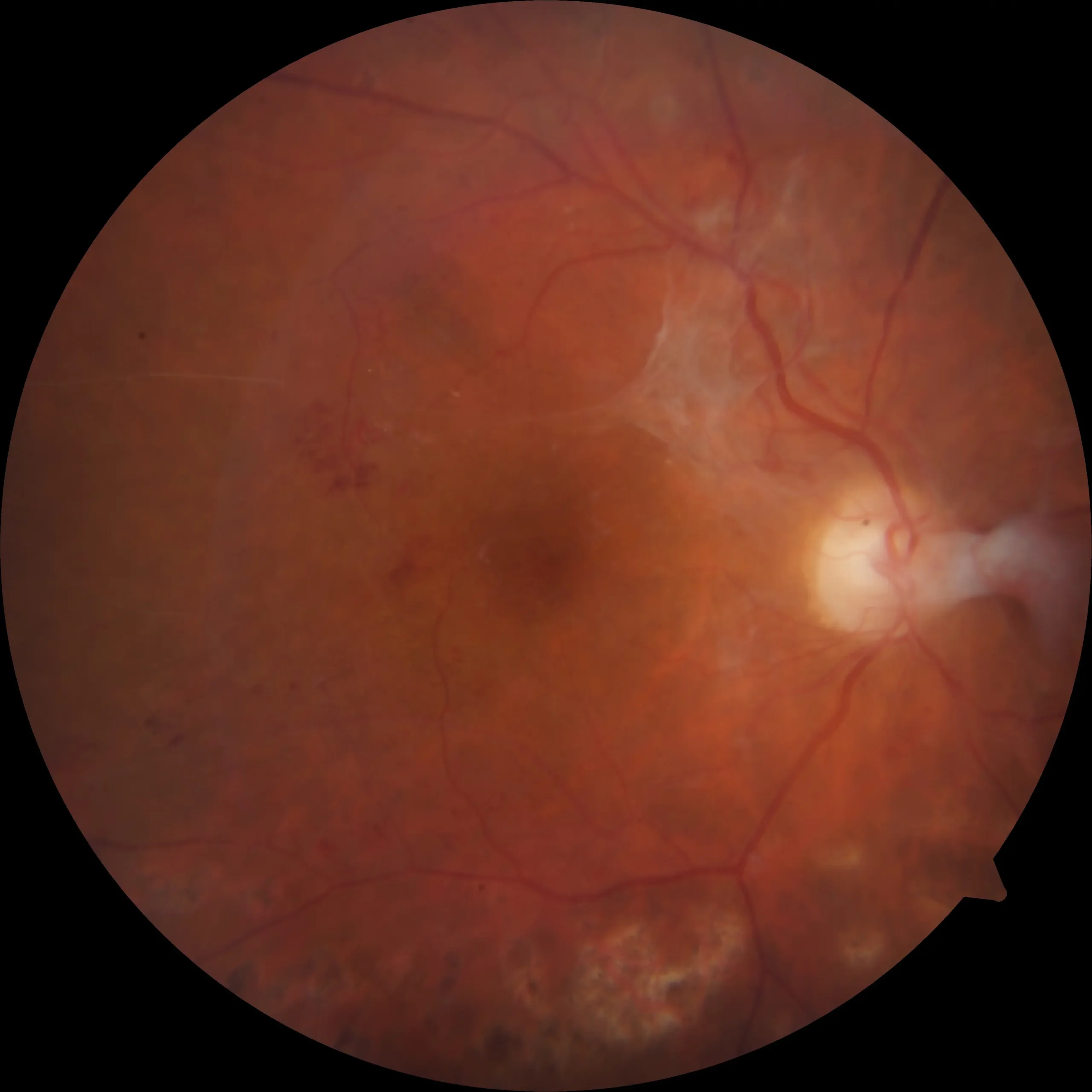 Retinopatia diabetica proliferante dottor roberto parisio oculista