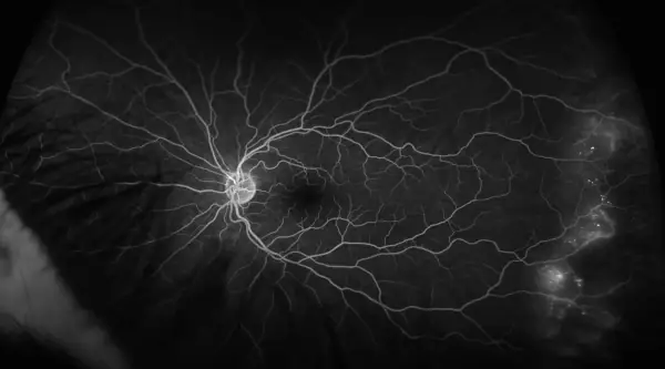 Fluorangiografia diagnostica dottor parisio