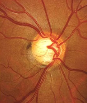 Glaucoma dottor roberto parisio oculista