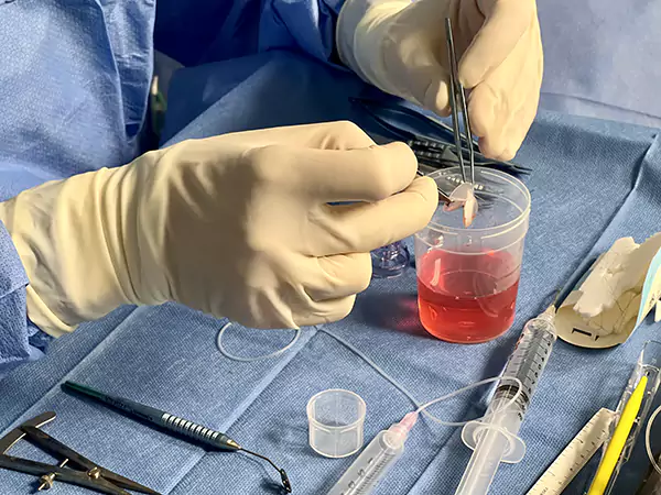 Trapianto cornea trattamenti dottor parisio