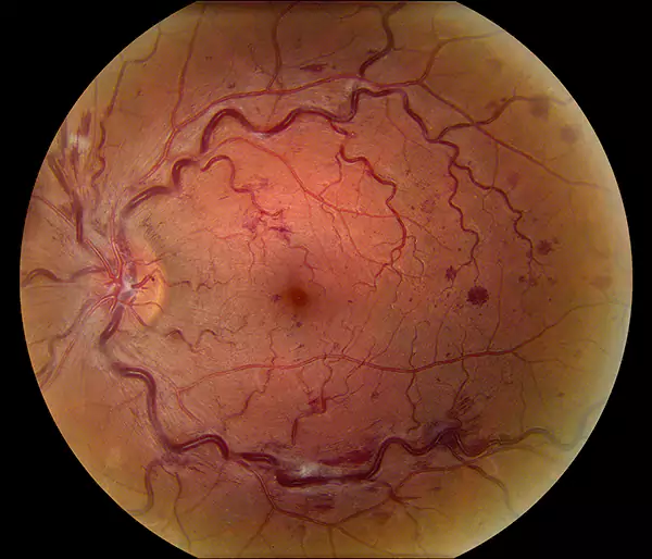 occlusione vascolare patologie dottor parisio
